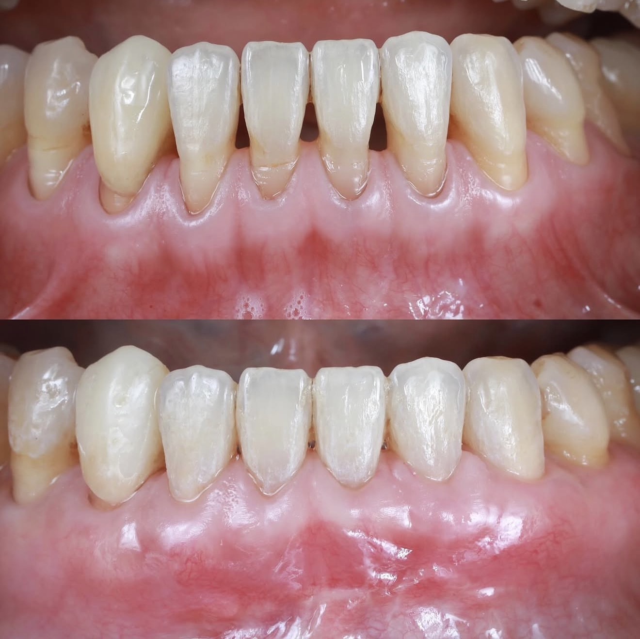 Clinical before and after papilla reconstruction