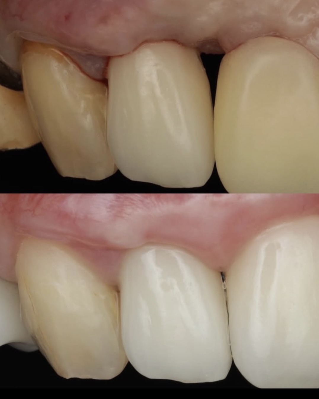 Clinical before and after SAPRe treatment